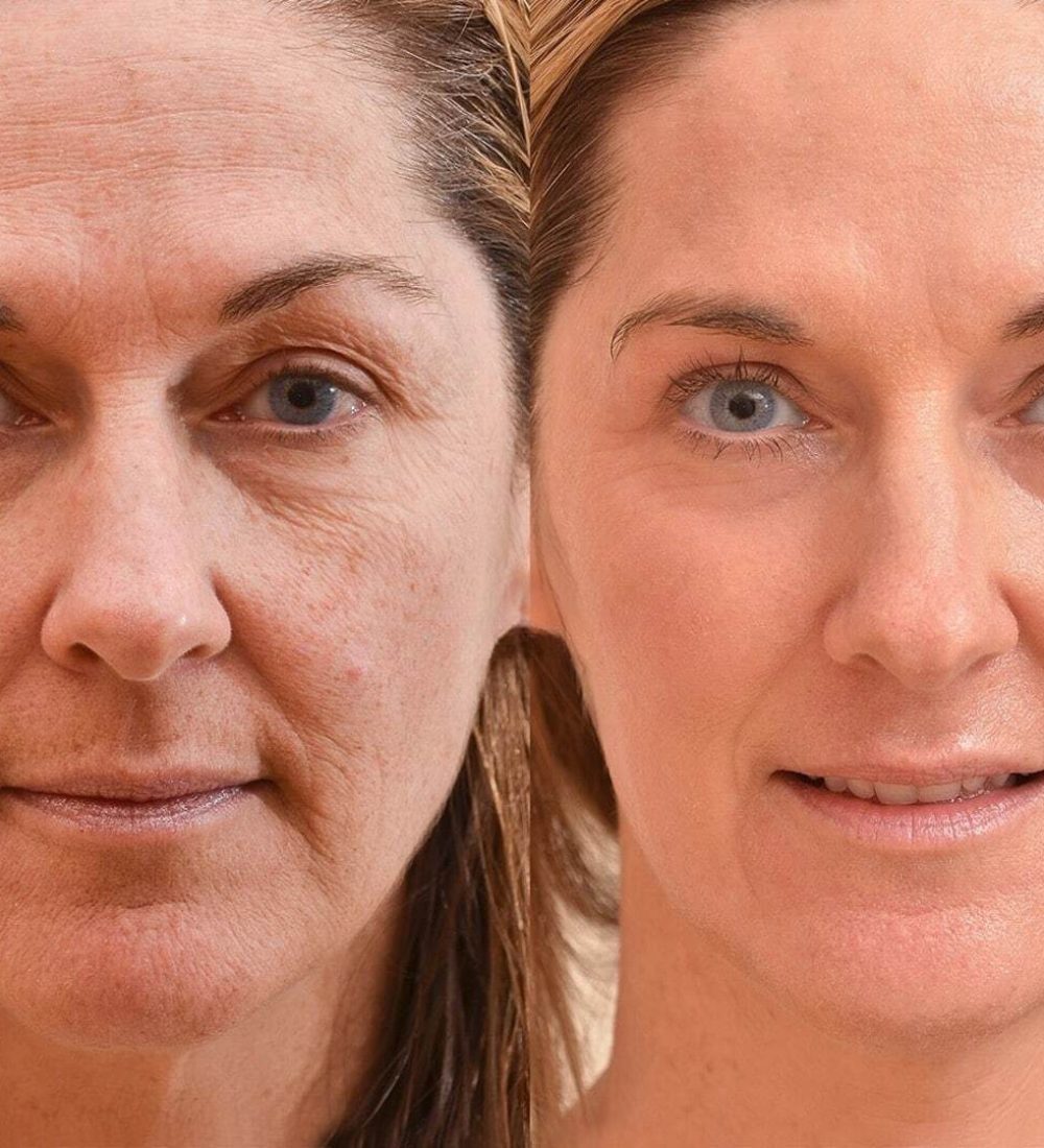 Full Ablative Resurfacing