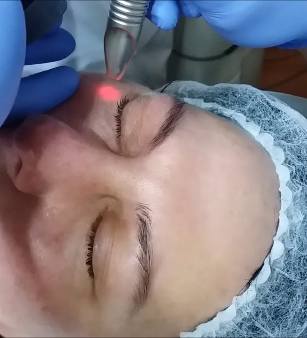 SmoothEye (Periorbital Tightening)